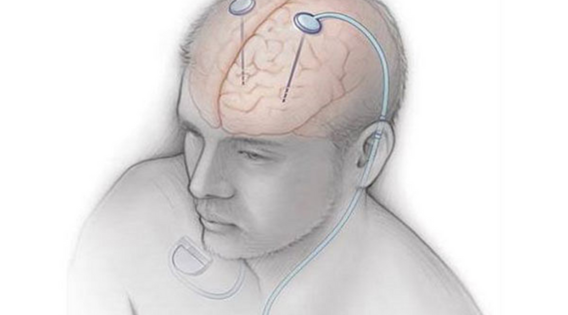Brain Pacemaker: A Revolutionary Treatment for Advanced Parkinsons' Disease